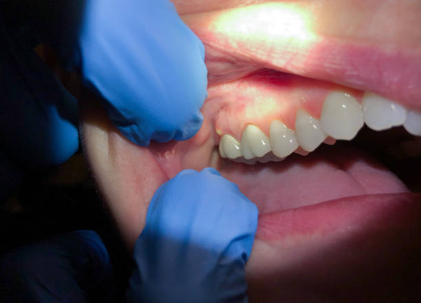 Best Emergency Root Canal Treatment in Mesita, NM